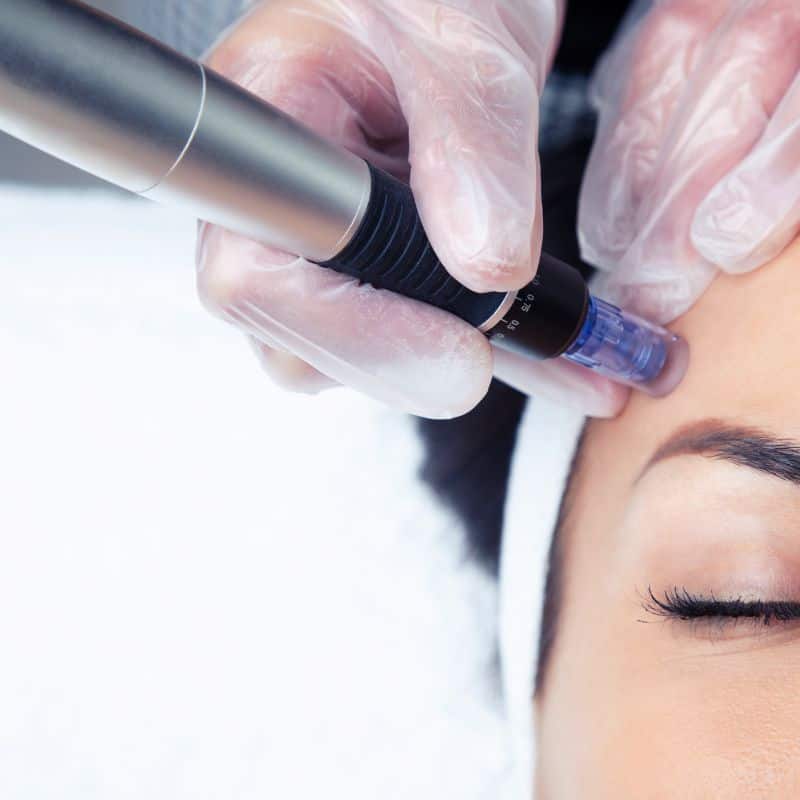 Morpheus8 treatment Stoke from Lipo Sculpt - Book in today!